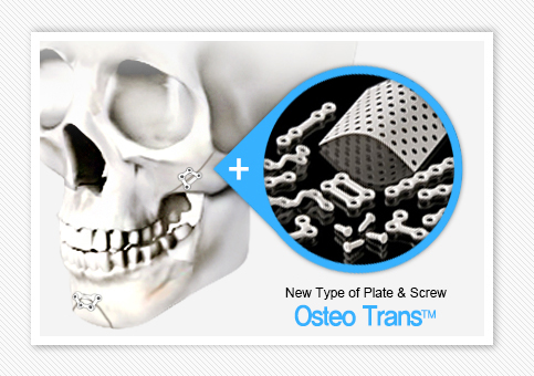 新概念的固定片&螺丝Osteo TransTM