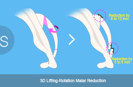 提升3D颧骨回转术